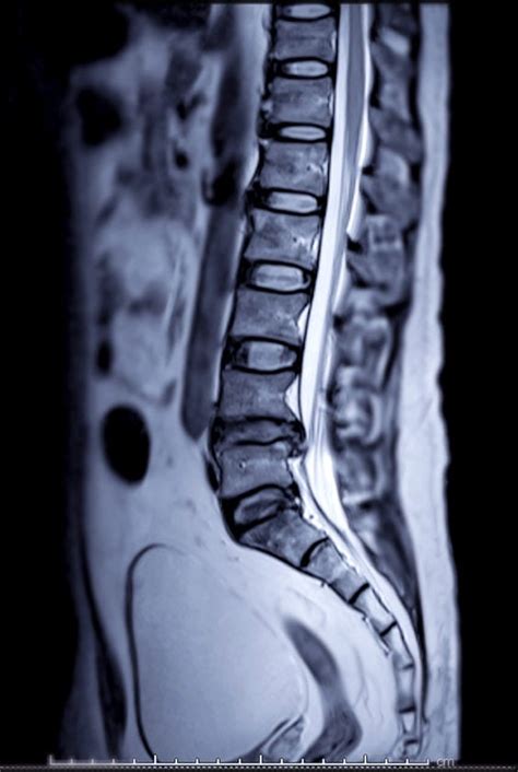 Spine MRI Results and Medical Decision Making: Get All Your Options