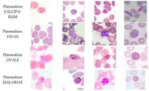 Plasmodium Vivax Vs Ovale