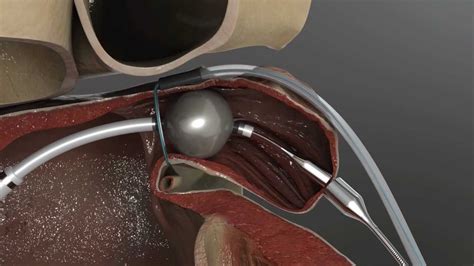 LARIAT Suture Delivery Device, Atrial Fibrillation and Stroke - YouTube