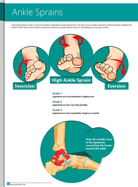 Symptoms Of A Sprained Ankle Sprained Ankle Sprain Ankle Sprain ...