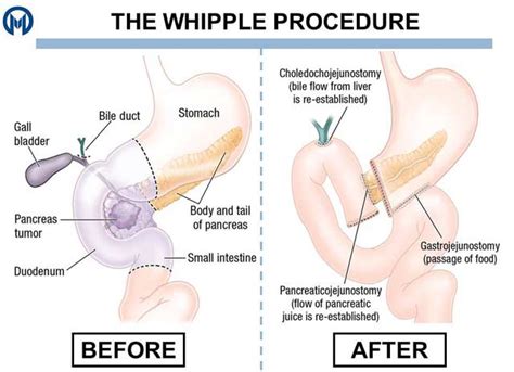 [Solved] What is the other name for pancreaticoduodenectomy?