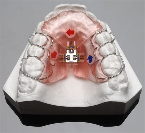 3-Way Palatal Expander/Orthodontic Expansion Appliance - China 3-Way ...