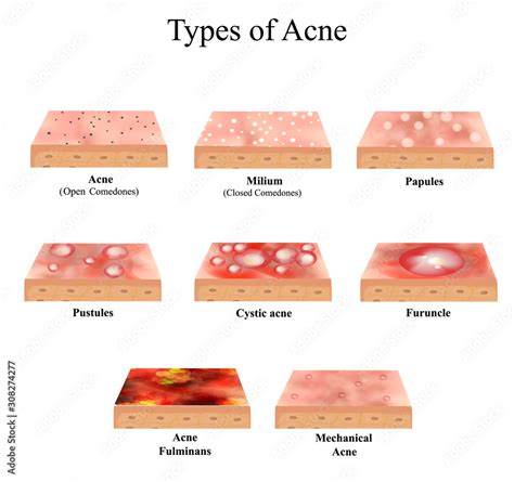 Types of Acne Skin inflammation. Pimples, boils, whitehead, closed ...