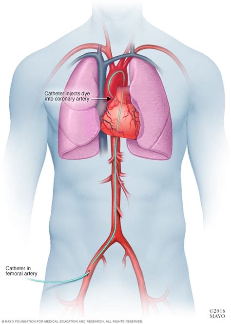 Coronary angiogram - Mayo Clinic