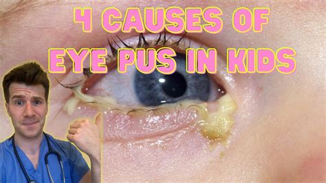 Doctor explains 4 causes of eye pus, discharge or sticky eyes in kids ...