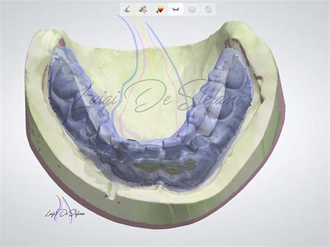 Removable implant-supported prosthesis. Case report - MyZerodonto