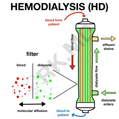 Renal Replacement Therapy - Hemodialysis and Hemofiltration | RK.MD