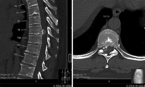 Herniated Disc Thoracic Mri