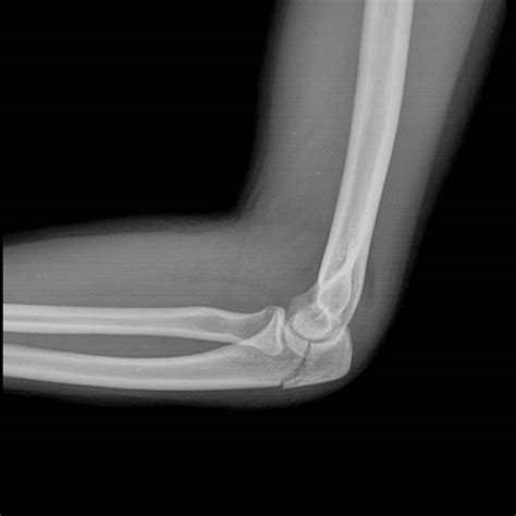 Olecranon Fractures – Core EM