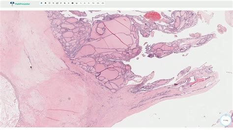 Multinodular Goiter Histology