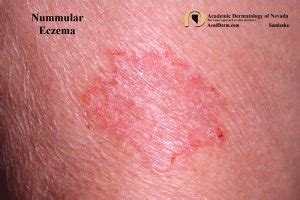 Nummular Eczema - Academic Dermatology of Nevada