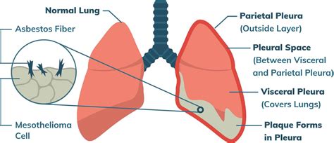 Pleural Mesothelioma | Stages, Treatment & Prognosis