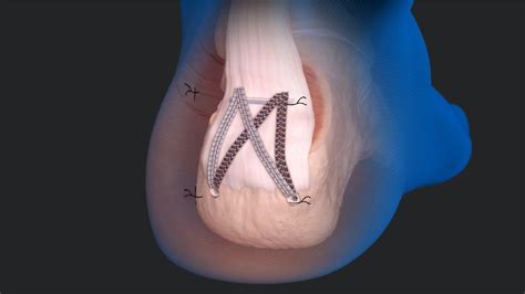 Arthrex - Minimally Invasive FiberTak® Achilles SpeedBridge™ Repair ...