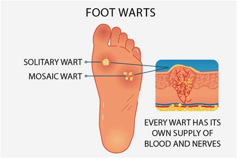 Plantar Warts Foot And Ankle Podiatrists, 47% OFF