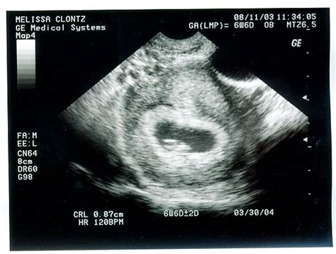 ultrasound one month | Baby ENGLISHfirst picture! | Baby month by month ...