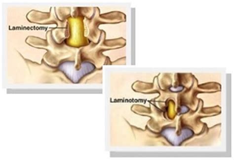 Laminotomy Vs Laminectomy - Which One to Choose?