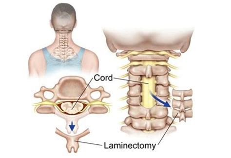 Laminotomy Vs Laminectomy - Which One to Choose?