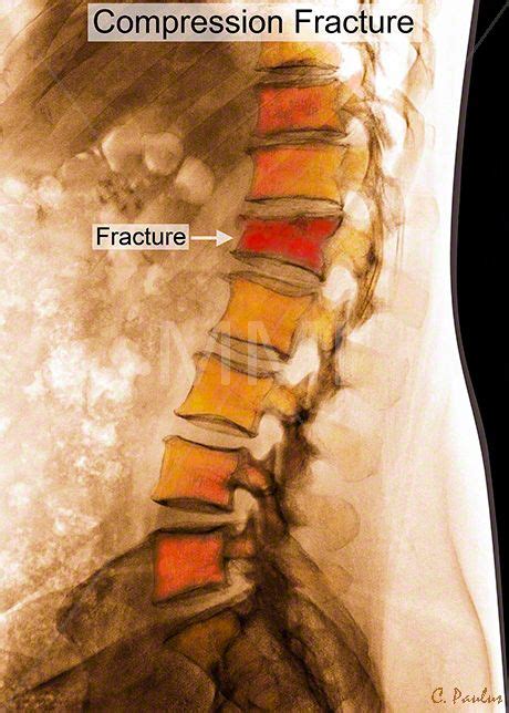 Annotated Color X Ray Lumbar Spine Compression Fracture | X ray, Lumbar ...