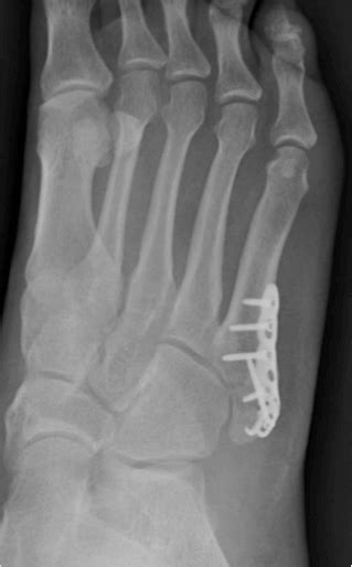 Jones Fracture | Mr Malik Orthopaedic Foot & Ankle Consultant