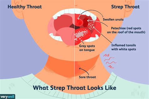 Everything You Need to Know About Strep Throat | Strep throat, Swollen ...