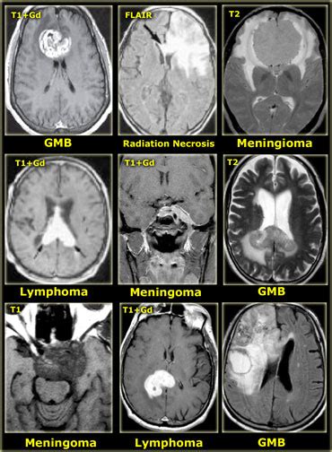 Brain Mri Scan Tumor