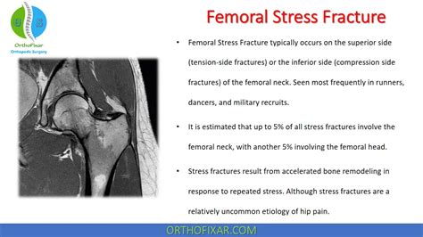 Femoral Stress Fracture | OrthoFixar 2024