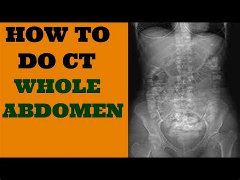 HOW TO DO CECT WHOLE ABDOMEN | ข้อมูลที่เกี่ยวข้องct whole abdomen คือ ...