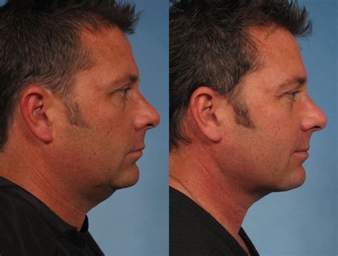 Male Face/Neck Lift Before and After Photo Gallery | Naples, FL | Kent ...