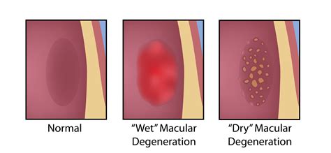 Macular Degeneration Treatment in California | AMD