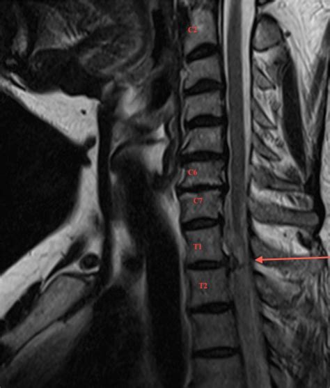 Herniated Disc Thoracic Mri