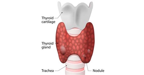 Thyroid Nodules: Symptoms, Causes, Diagnosis, Treatment, Complications ...