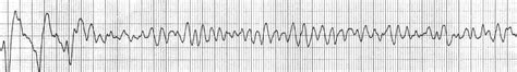 Ventricular Fibrillation (VF) • LITFL • ECG Library Diagnosis