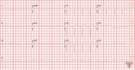 Left Ventricular Aneurysm | ECG Stampede