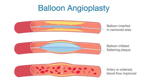 Types of Stents: All Types of Coronary Stents & Their Uses | Meril Life