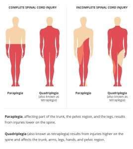 What Damages Am I Entitled to If I Suffer Paralysis as the Result of an ...