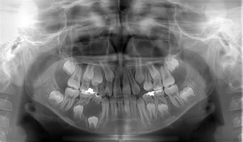 Panoramic radiograph taken at the first visit showing the dentigerous ...