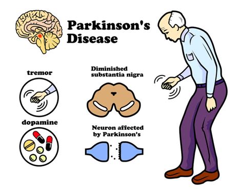 Parkinson's Disease Symptoms, Causes, Diagnosis & Treatment - HealthPulls