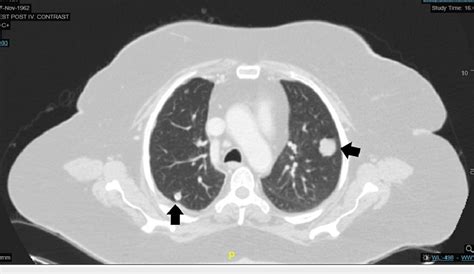 CT scan of chest showing multiple lung metastases (black arrows ...