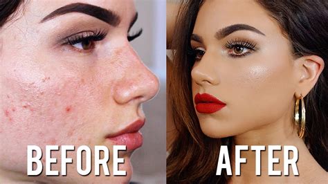 How To Cover ACNE & SCARS with Makeup! Full Coverage Foundation ...