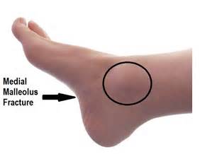 Ankle undisplaced medial malleolus fracture · Virtual Fracture Clinic