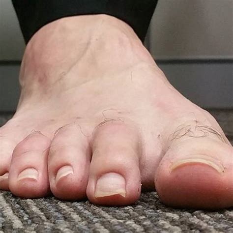 Before & After | Podiatric Surgery Centre