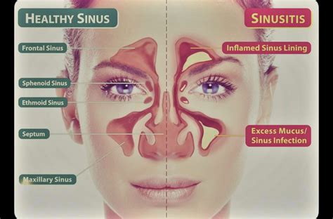 Balloon Sinuplasty: The Fix for Sinusitis - Michigan ENT, Allergy ...