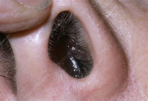 Nasal polyp - Stock Image - M240/0475 - Science Photo Library