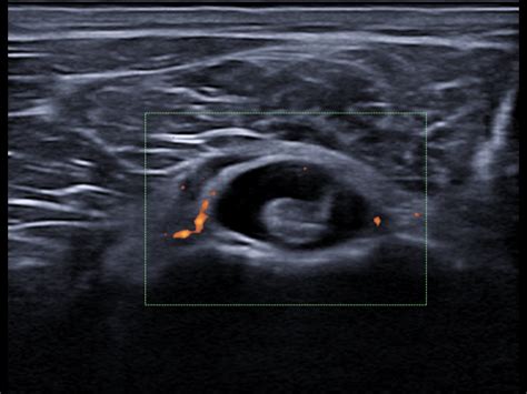 Long head of the biceps tenosynovitis | Ultrasound Cases