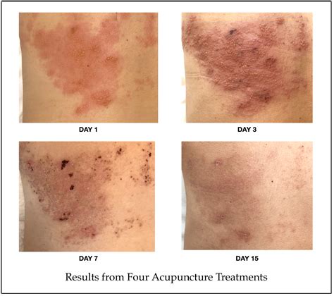 Eczema | Shingles | Verruca | Acupuncture in Brighton | Skin Clnic