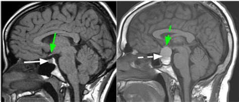 Pituitary Mri