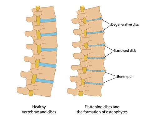 Degenerative Disc In Thoracic Spine