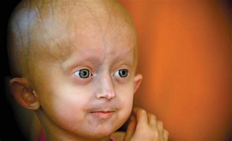 progeria | Definition, Types, Symptoms, & Facts | Britannica