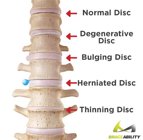 Bulging Disc Pain