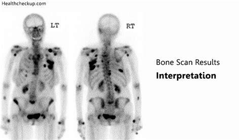 Bone Scan Results Interpretation | Bone Scan Side Effects | Health Checkup